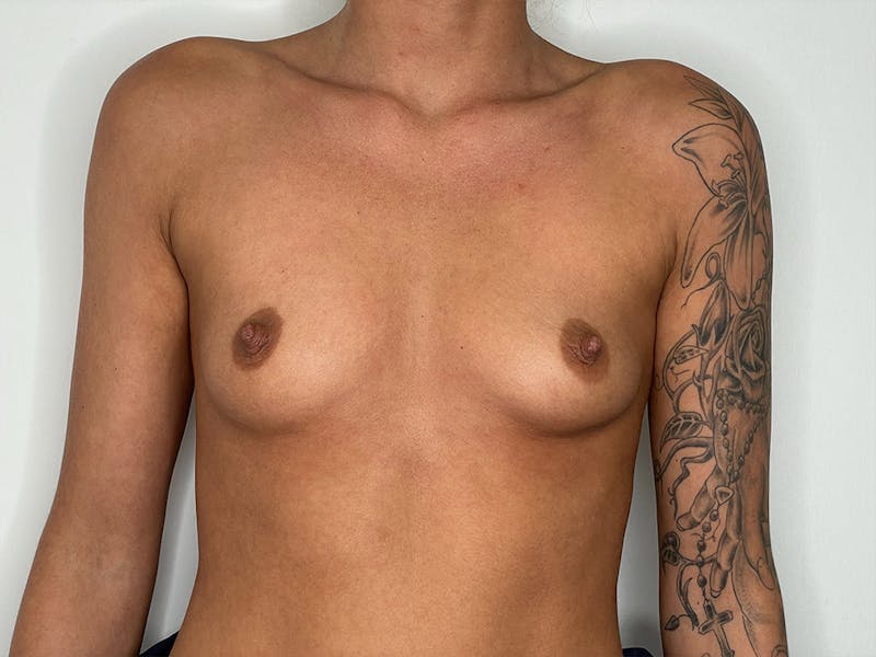 Breast Augmentation Before & After Gallery - Patient 106999863 - Image 1
