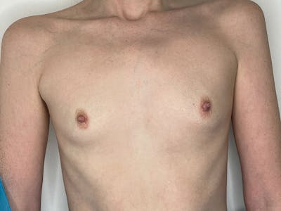Breast Augmentation Before & After Gallery - Patient 106999867 - Image 1