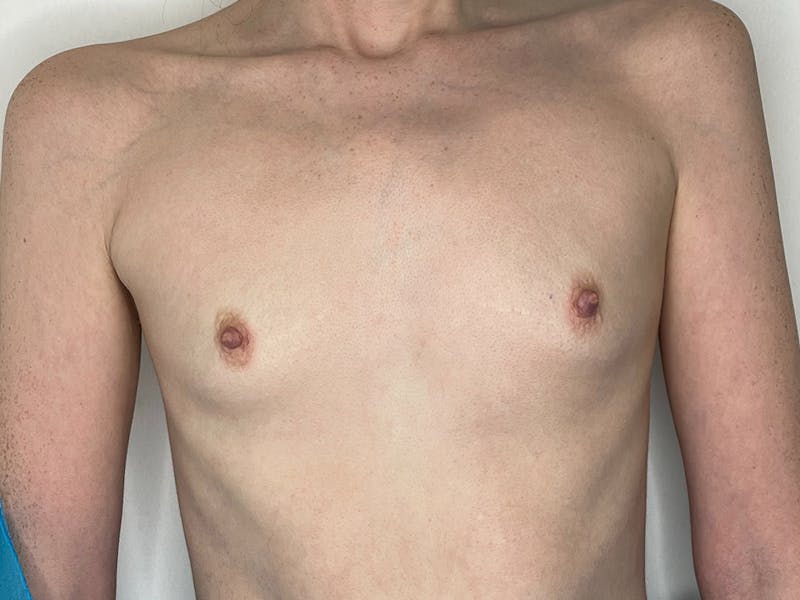 Breast Augmentation Before & After Gallery - Patient 106999867 - Image 1