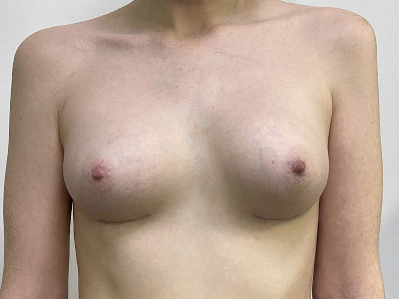 Breast Augmentation Before & After Gallery - Patient 106999867 - Image 2
