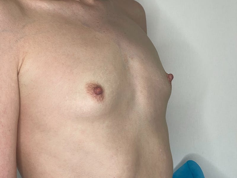 Breast Augmentation Before & After Gallery - Patient 106999867 - Image 3