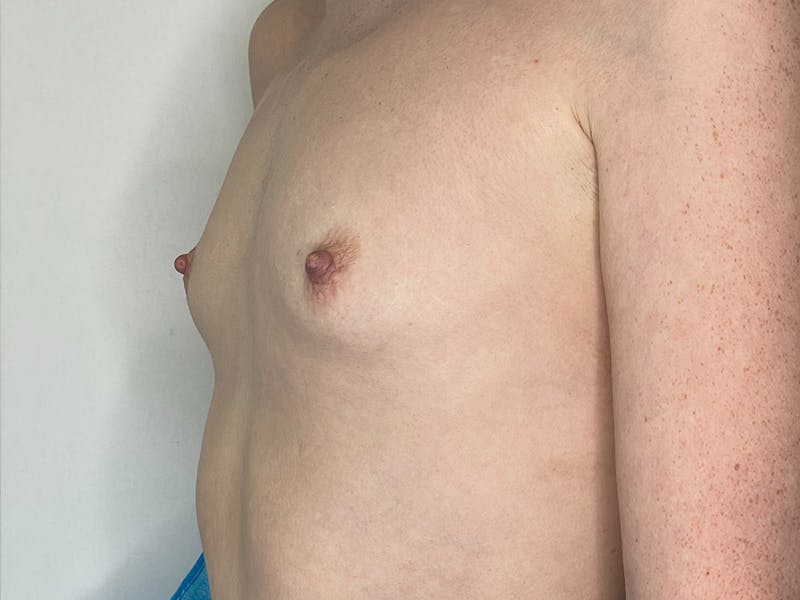 Breast Augmentation Before & After Gallery - Patient 106999867 - Image 5
