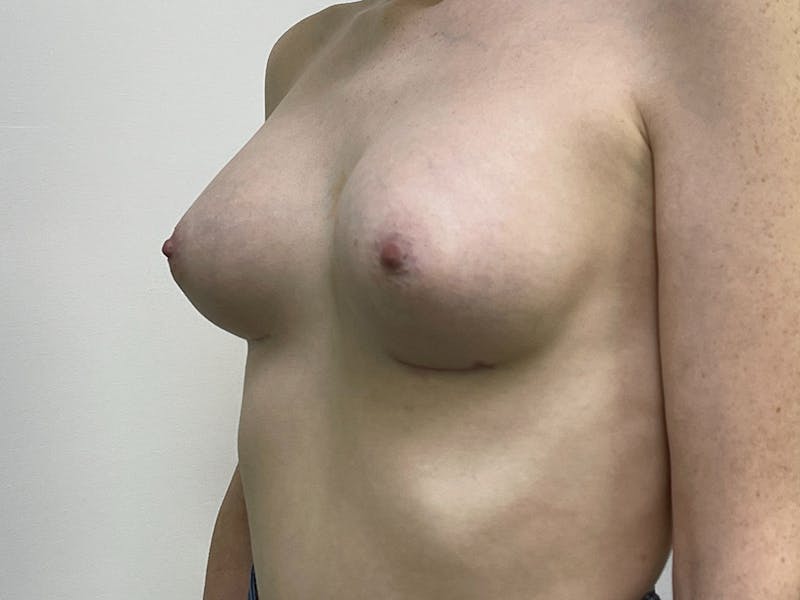 Breast Augmentation Before & After Gallery - Patient 106999867 - Image 6