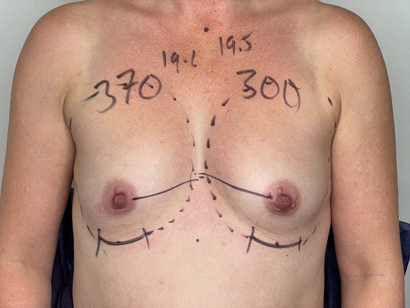 Breast Augmentation Before & After Gallery - Patient 106999876 - Image 1