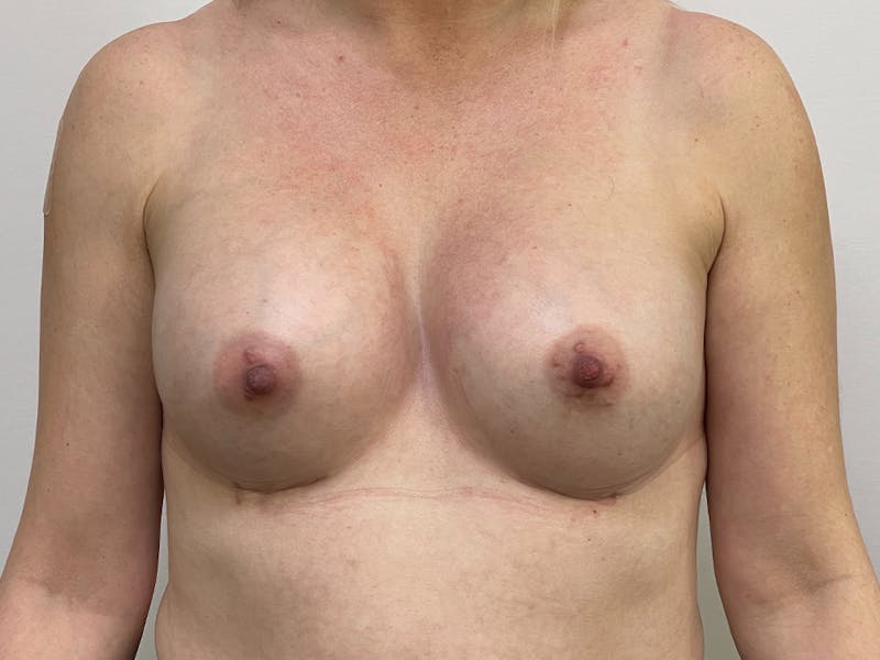 Breast Augmentation Before & After Gallery - Patient 106999876 - Image 2