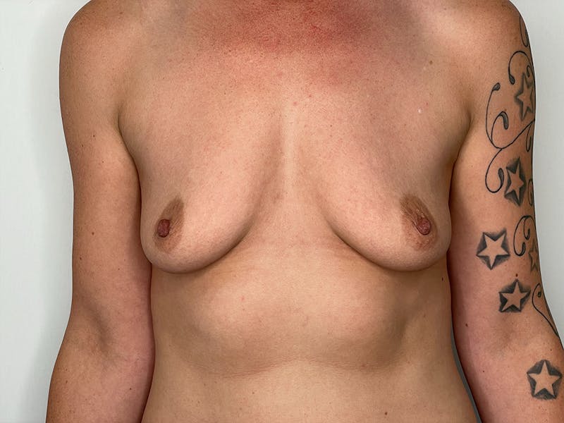 Breast Augmentation Before & After Gallery - Patient 106999877 - Image 1