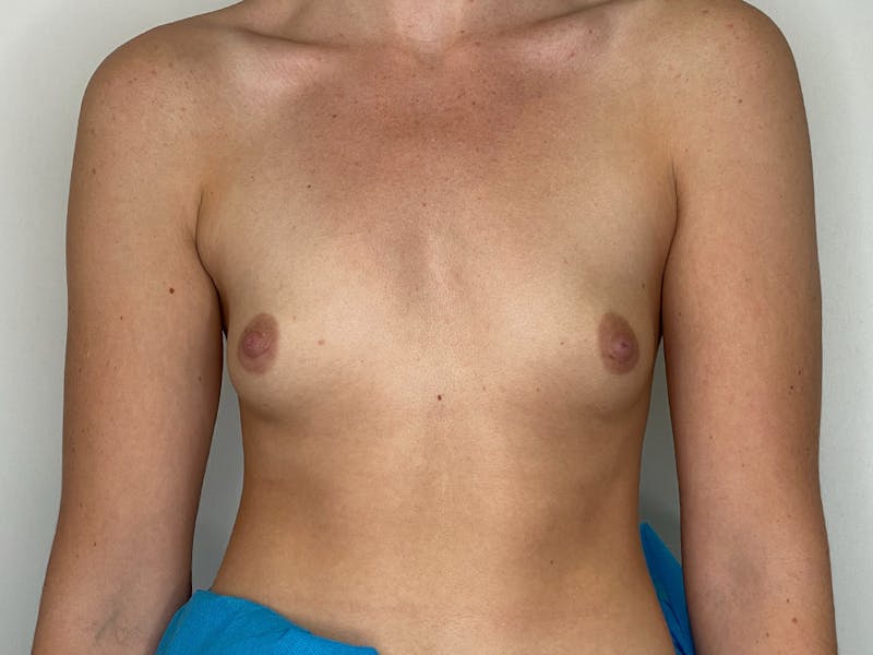 Breast Augmentation Before & After Gallery - Patient 106999878 - Image 1