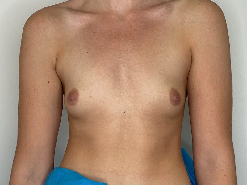 Breast Augmentation Before & After Gallery - Patient 106999878 - Image 1