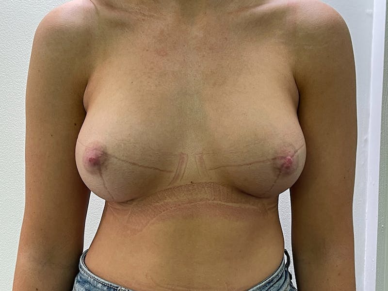 Breast Augmentation Before & After Gallery - Patient 106999878 - Image 2
