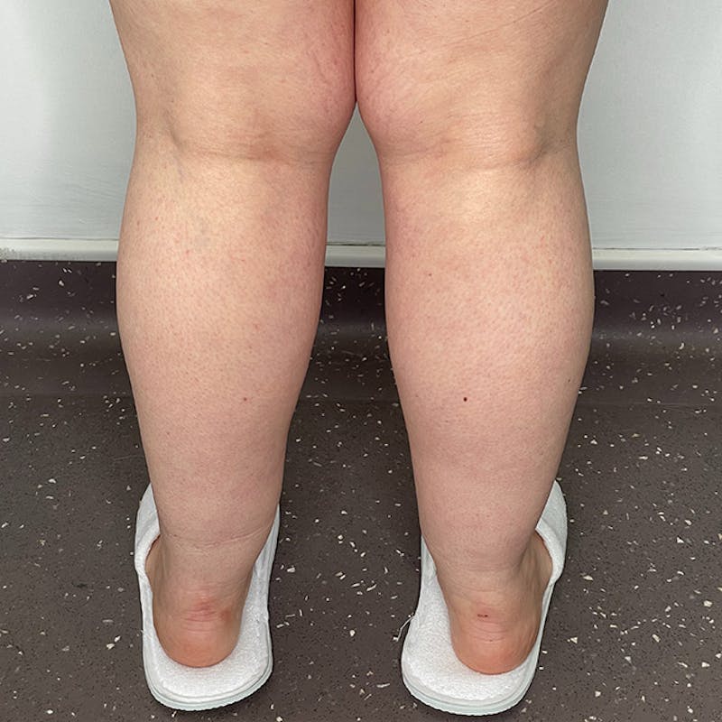 Liposuction Before & After Gallery - Patient 106999933 - Image 2