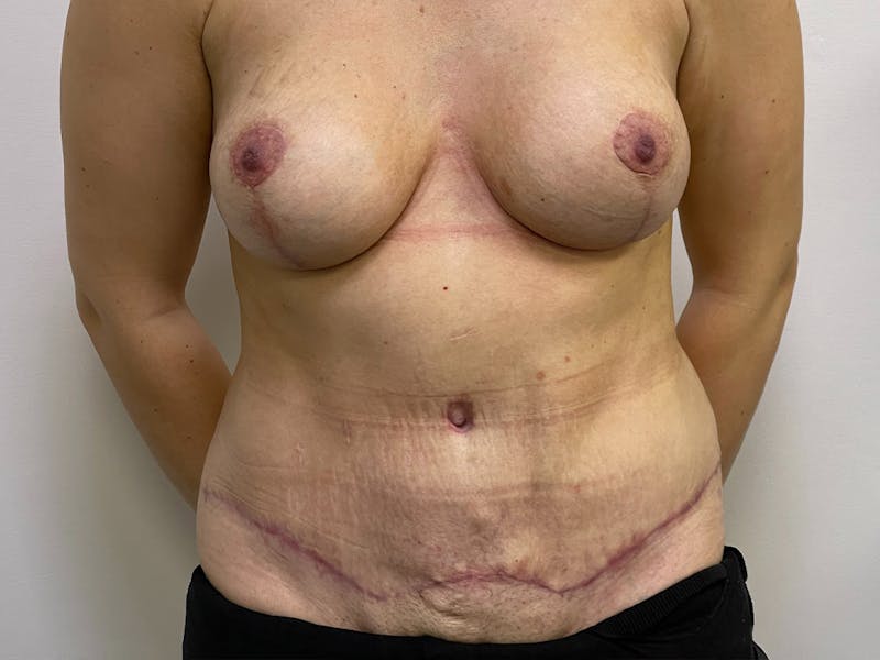 Tummy Tuck Before & After Gallery - Patient 106999940 - Image 2