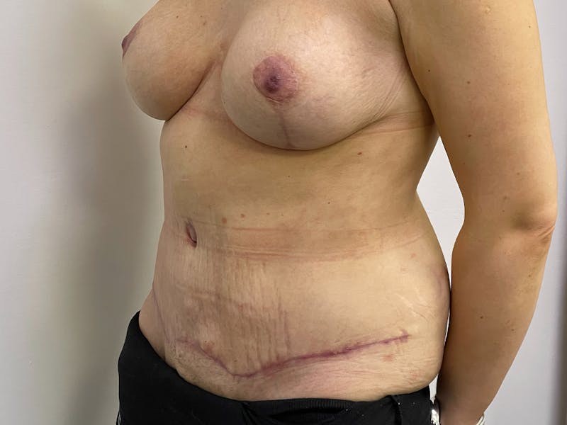 Tummy Tuck Before & After Gallery - Patient 106999940 - Image 4