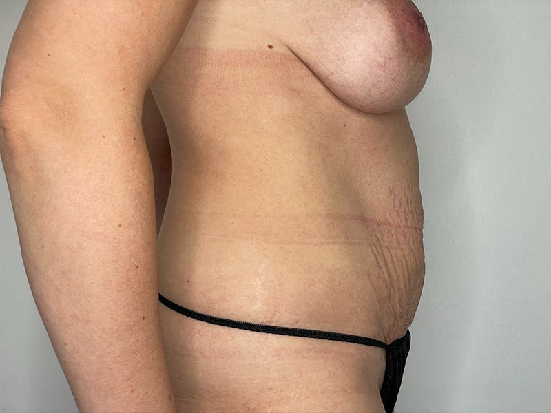 Tummy Tuck Before & After Gallery - Patient 106999940 - Image 5