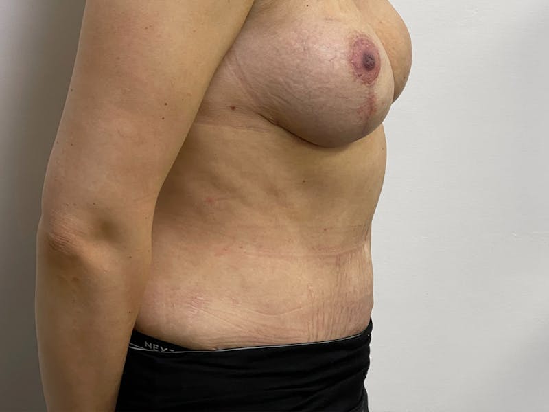Tummy Tuck Before & After Gallery - Patient 106999940 - Image 6