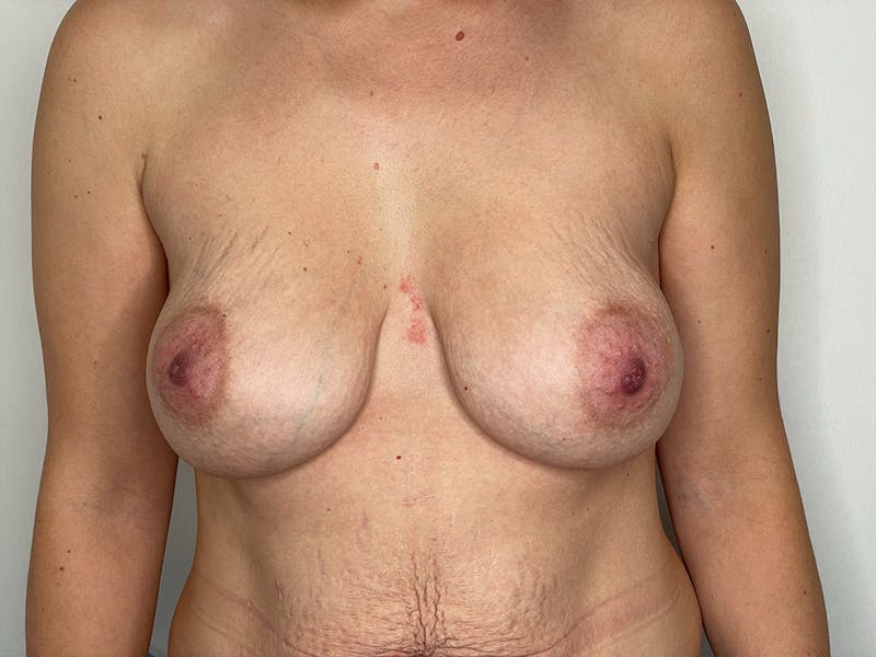 Exchange of Breast Implants Before & After Gallery - Patient 106999951 - Image 1
