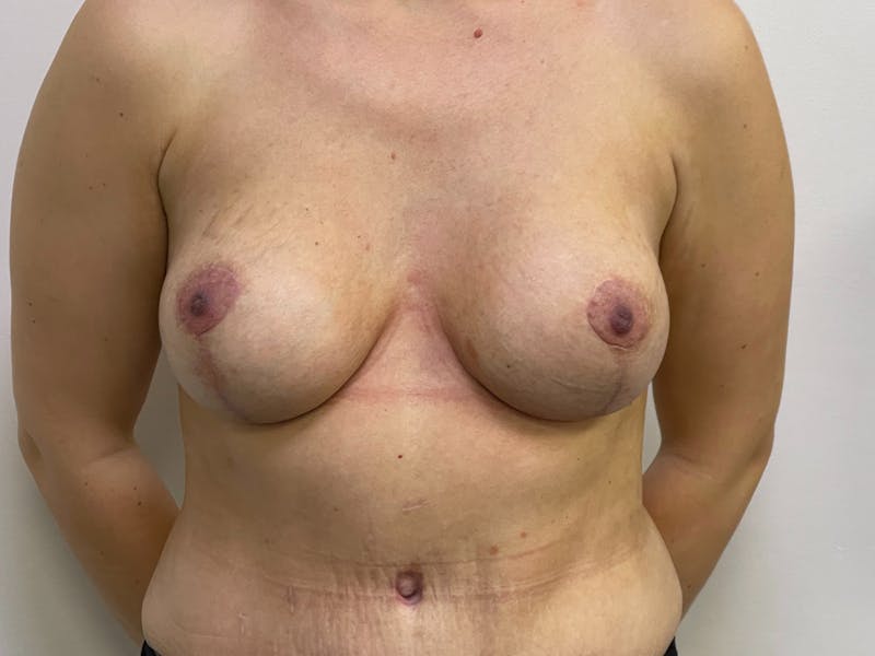 Breast Uplift with Implants Before & After Gallery - Patient 106999953 - Image 2