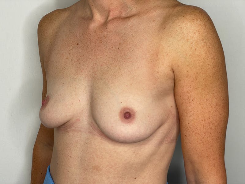 Breast Augmentation Before & After Gallery - Patient 115307105 - Image 1