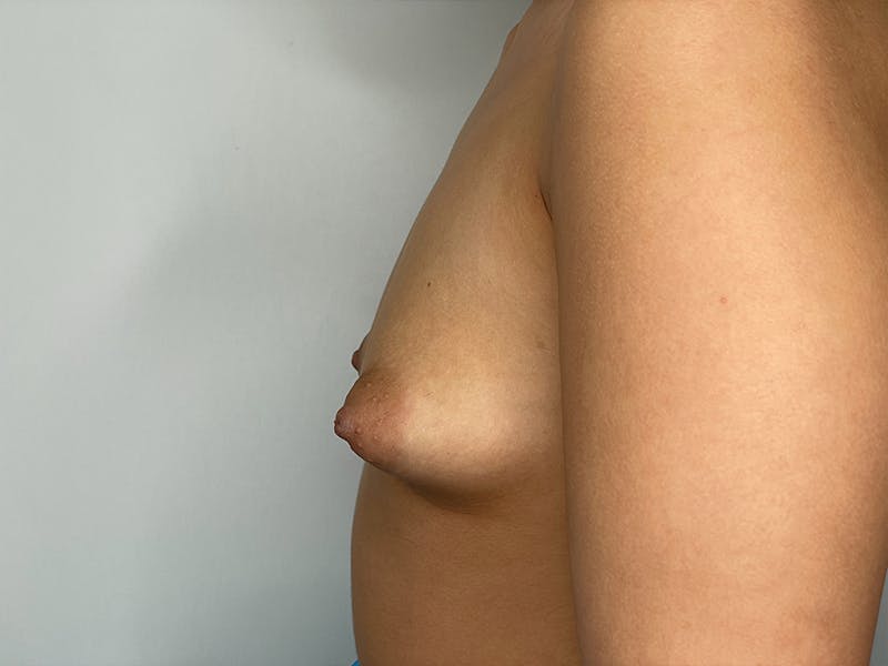 Breast Augmentation Before & After Gallery - Patient 115307107 - Image 3