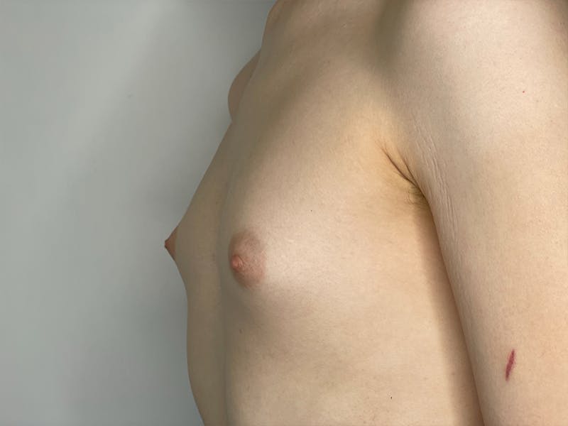 Breast Augmentation Before & After Gallery - Patient 115307108 - Image 1