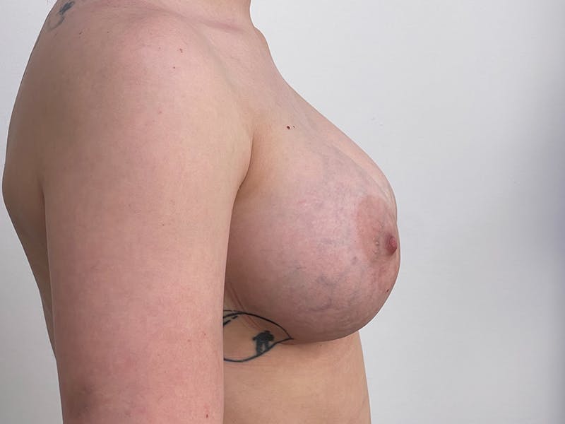 Breast Augmentation Before & After Gallery - Patient 115307109 - Image 4