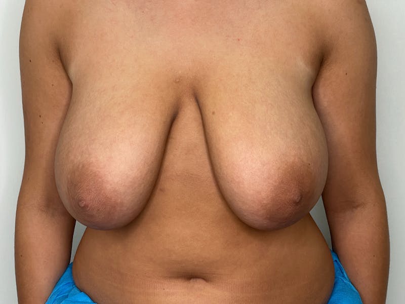 Breast Reduction  Before & After Gallery - Patient 115307210 - Image 1