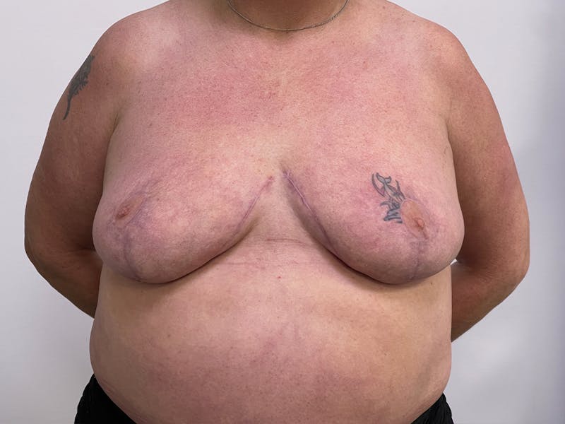 Breast Reduction  Before & After Gallery - Patient 115307211 - Image 2