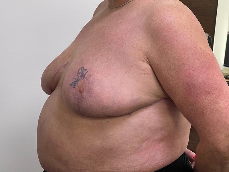 Breast Reduction  Before & After Gallery - Patient 115307211 - Image 4