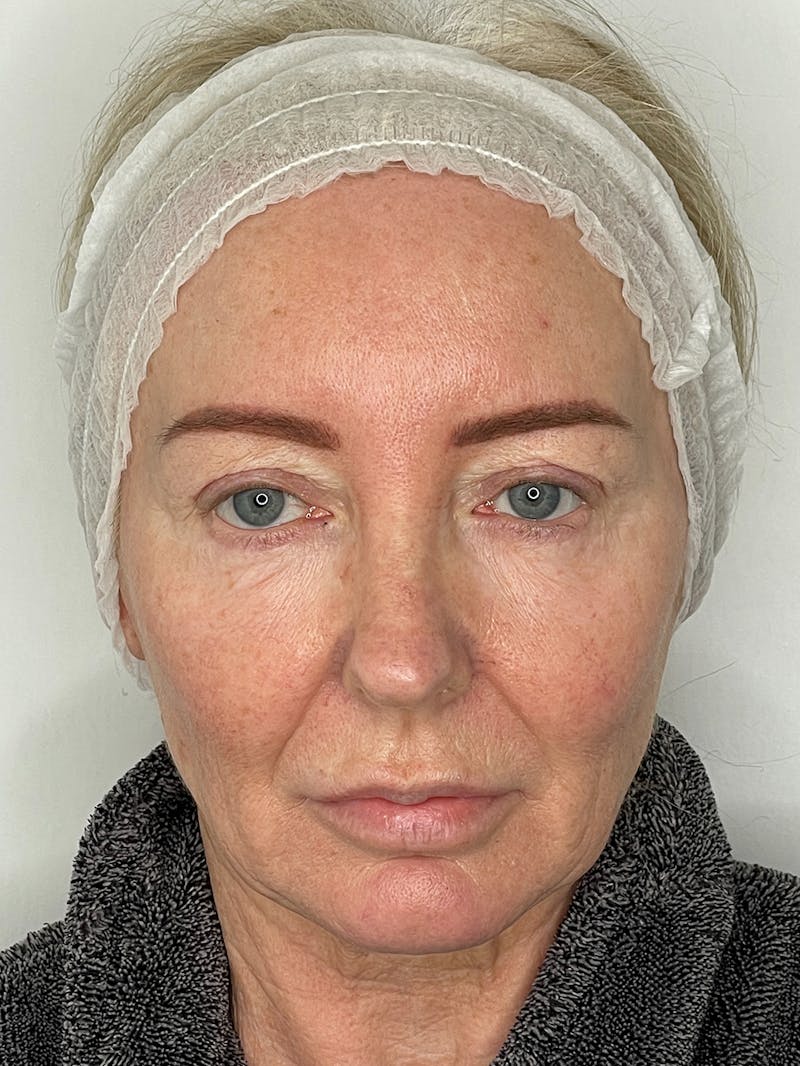 CO2 Laser Resurfacing Before & After Gallery - Patient 115307332 - Image 1