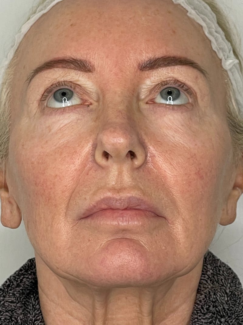 CO2 Laser Resurfacing Before & After Gallery - Patient 115307332 - Image 3