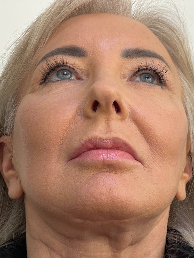 CO2 Laser Resurfacing Before & After Gallery - Patient 115307332 - Image 4