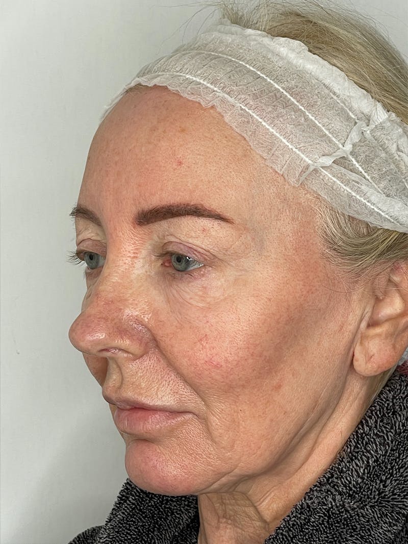 CO2 Laser Resurfacing Before & After Gallery - Patient 115307332 - Image 5