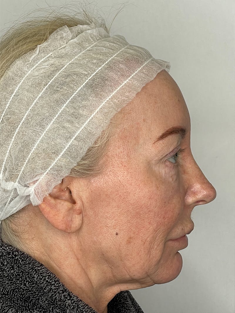 CO2 Laser Resurfacing Before & After Gallery - Patient 115307332 - Image 7