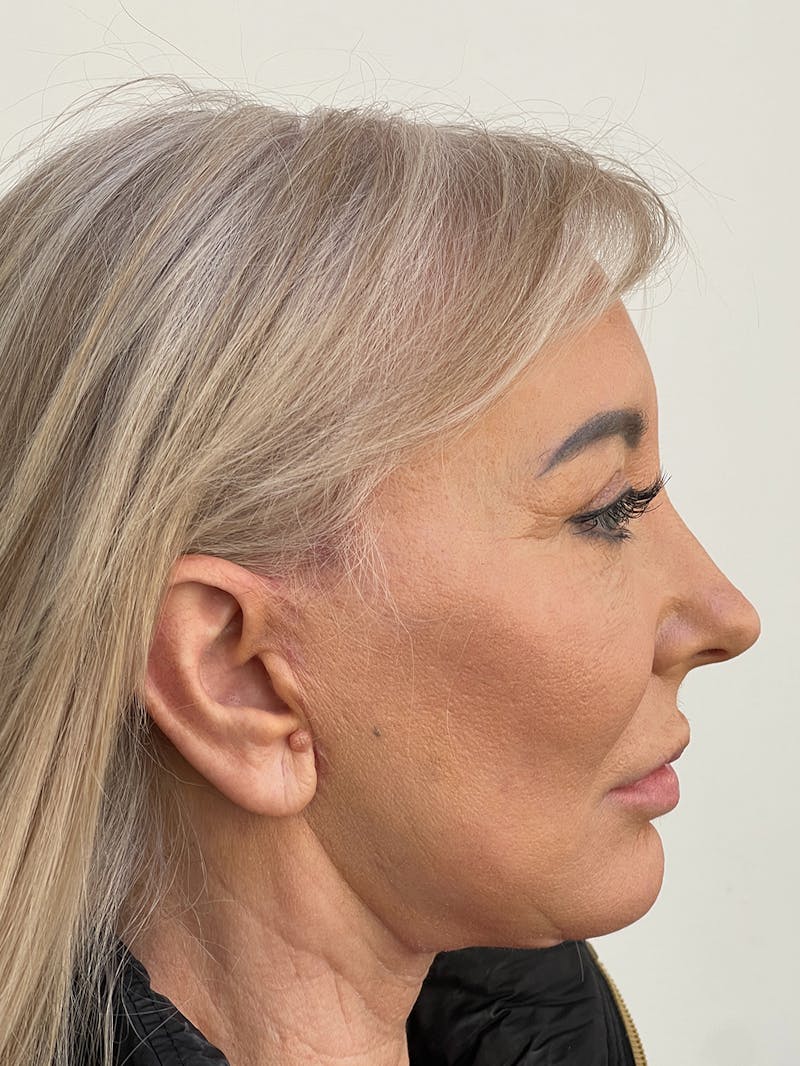 CO2 Laser Resurfacing Before & After Gallery - Patient 115307332 - Image 8