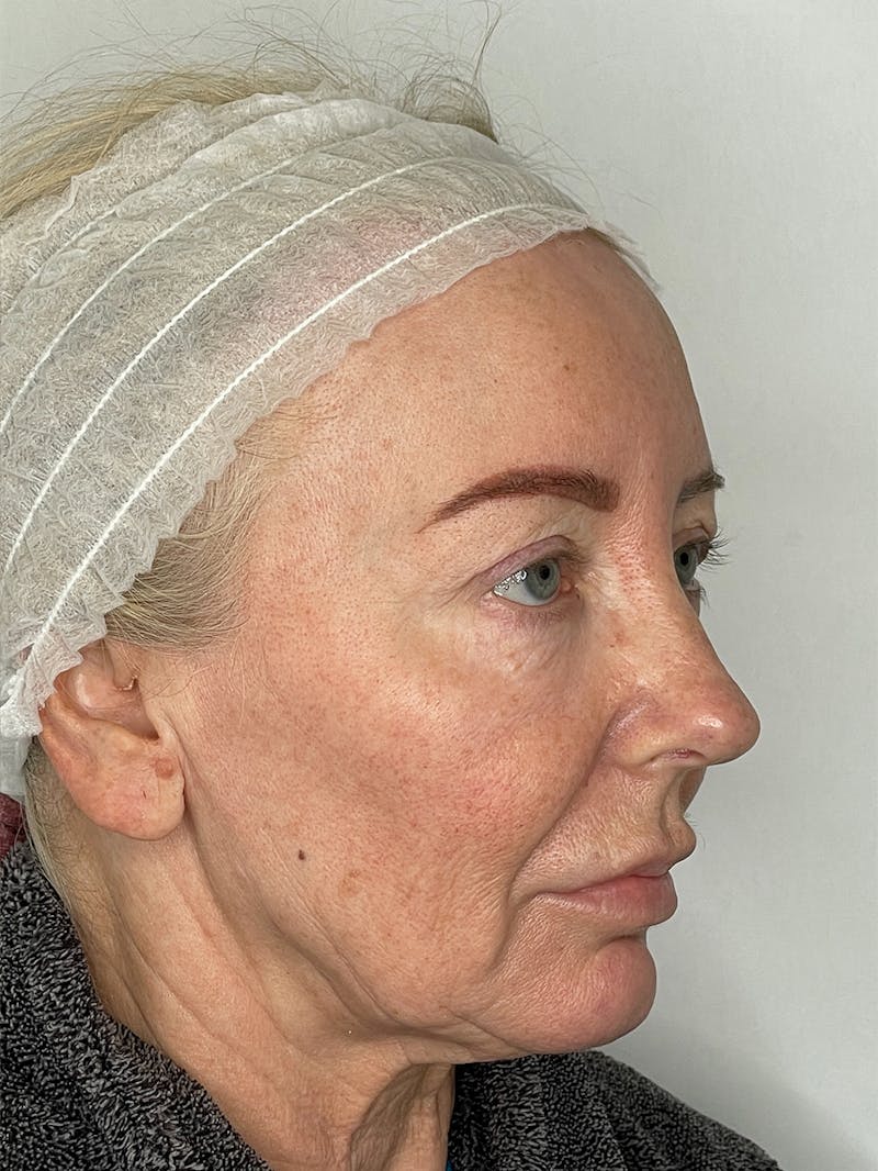 CO2 Laser Resurfacing Before & After Gallery - Patient 115307332 - Image 9