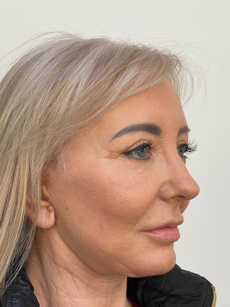 CO2 Laser Resurfacing Before & After Gallery - Patient 115307332 - Image 10