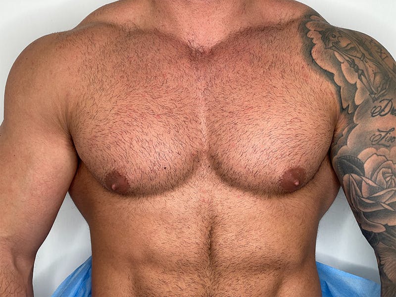 Gynecomastia (Male Breast Reduction) Before & After Gallery - Patient 115307423 - Image 1