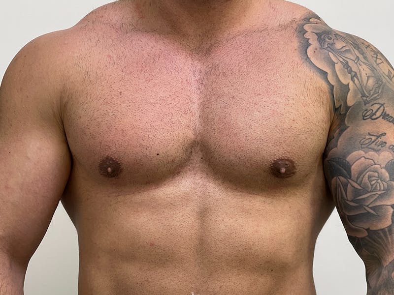Gynecomastia (Male Breast Reduction) Before & After Gallery - Patient 115307423 - Image 2