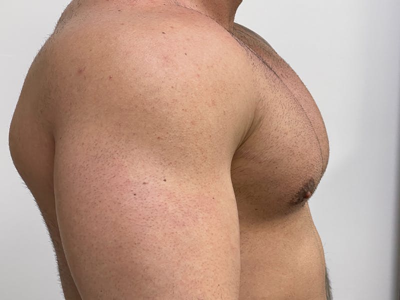 Gynecomastia (Male Breast Reduction) Before & After Gallery - Patient 115307423 - Image 4