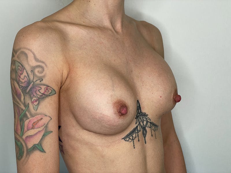 Exchange of Breast Implants Before & After Gallery - Patient 115307448 - Image 3