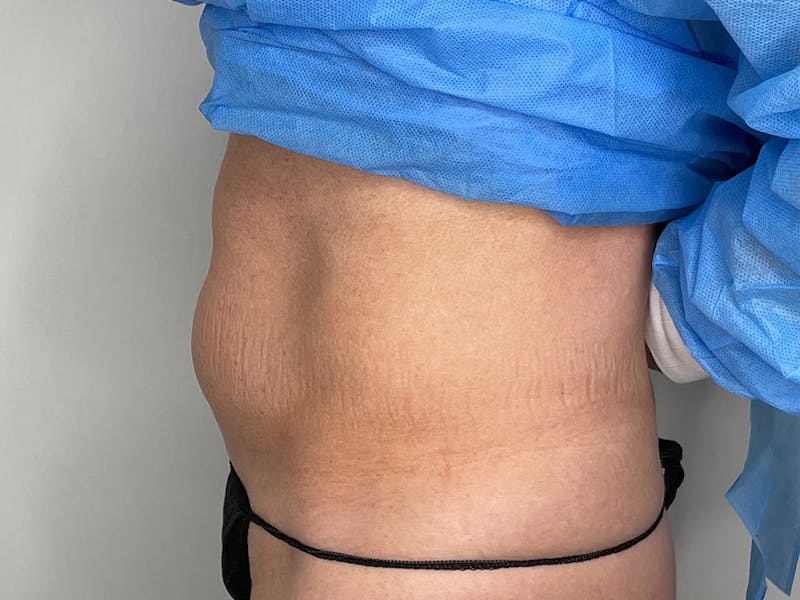 Vaser/Smart Liposuction Before & After Gallery - Patient 115307456 - Image 1