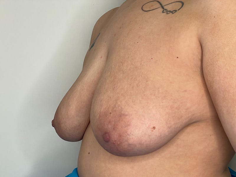 Breast Uplift with Implants Before & After Gallery - Patient 115307471 - Image 1
