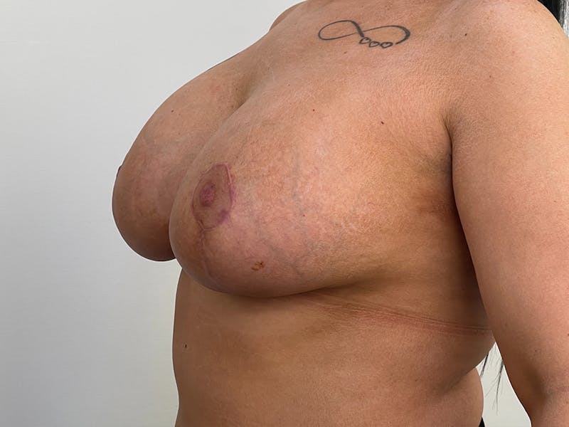 Breast Uplift with Implants Before & After Gallery - Patient 115307471 - Image 2