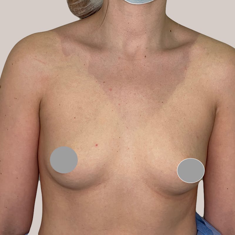 Breast Augmentation Before & After Gallery - Patient 93812210 - Image 1