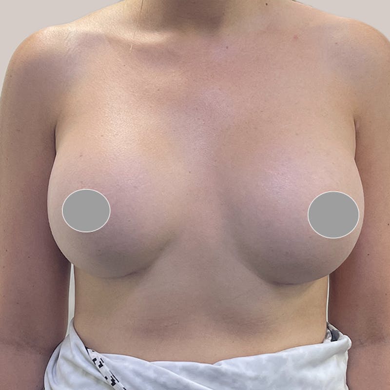 Breast Augmentation Before & After Gallery - Patient 93812210 - Image 2