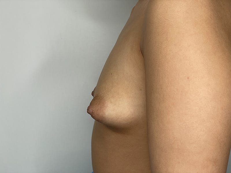 Breast Augmentation Before & After Gallery - Patient 121144505 - Image 3
