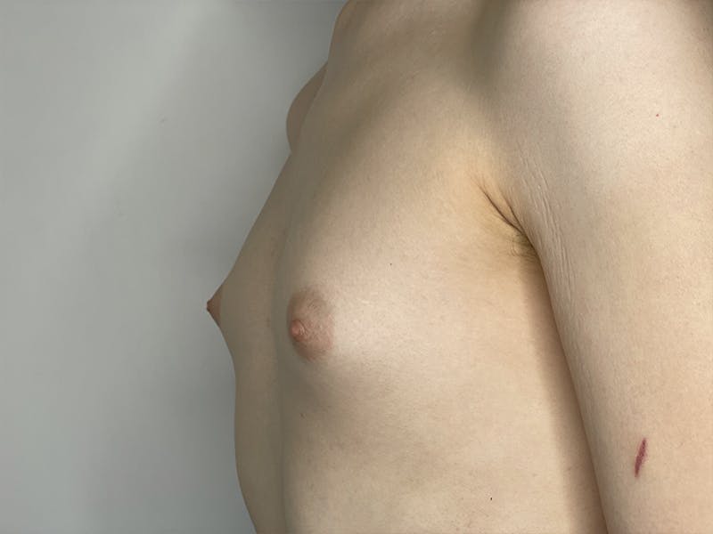 Breast Augmentation Before & After Gallery - Patient 121144506 - Image 1