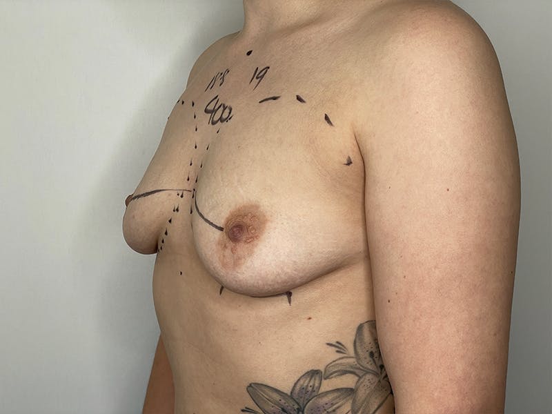 Breast Augmentation Before & After Gallery - Patient 121144507 - Image 1