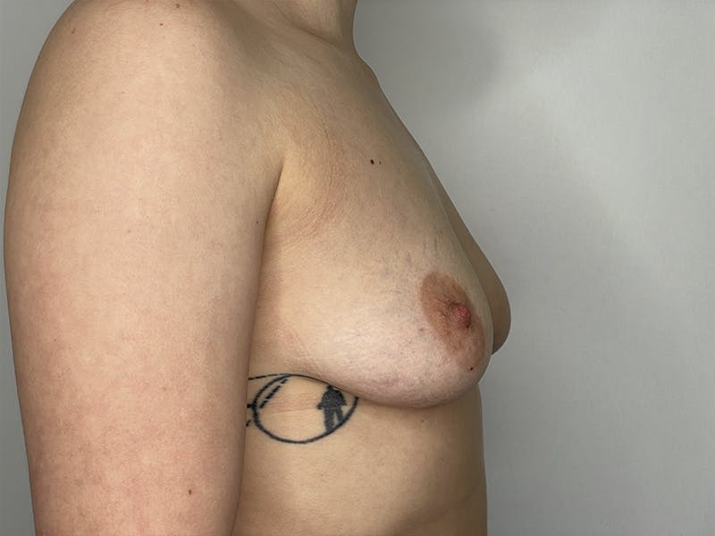 Breast Augmentation Before & After Gallery - Patient 121144507 - Image 3