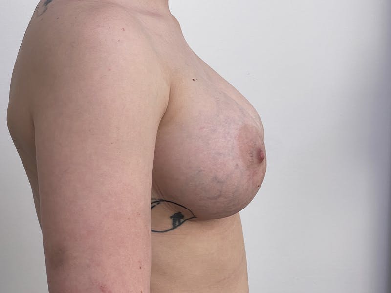 Breast Augmentation Before & After Gallery - Patient 121144507 - Image 4