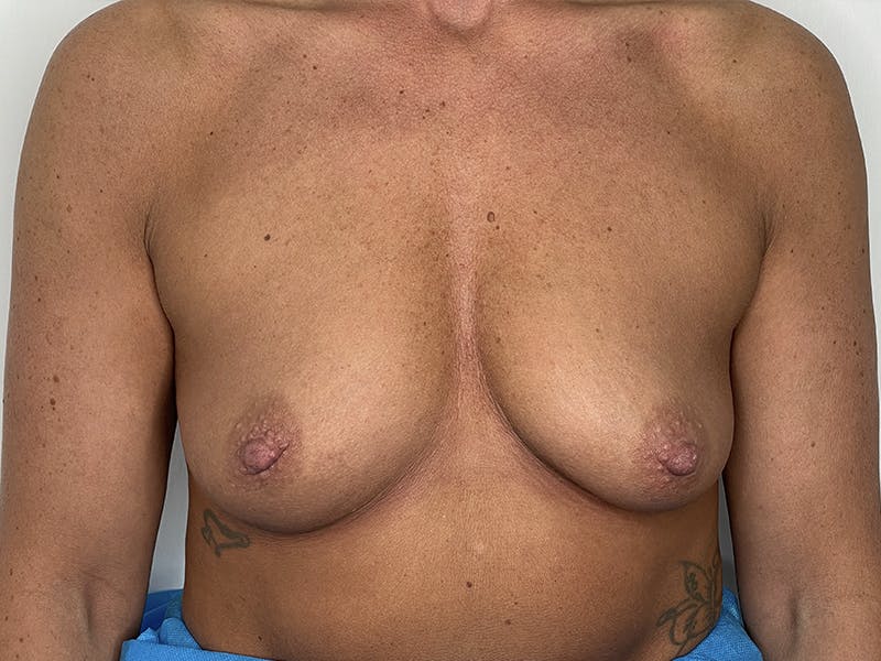 Breast Augmentation Before & After Gallery - Patient 121144508 - Image 1